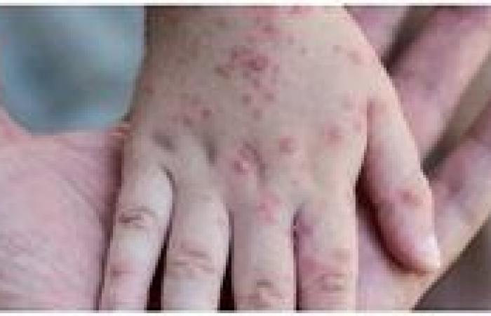 India Reports Its First Case of Virulent Mpox Virus Strain