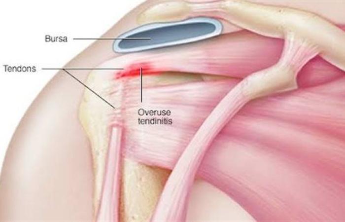 التهاب الأوتار.. الأسباب والأعراض وطرق العلاج