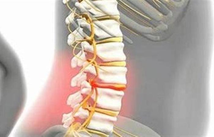 أستاذ جراحة: التدخين من مسببات الانزلاق الغضروفي