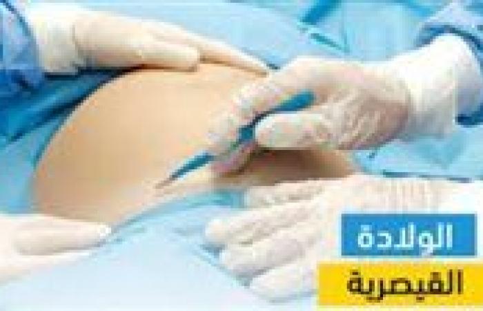 مستشار وزير الصحة: مصر تتصدر دول العالم في الولادة القيصرية