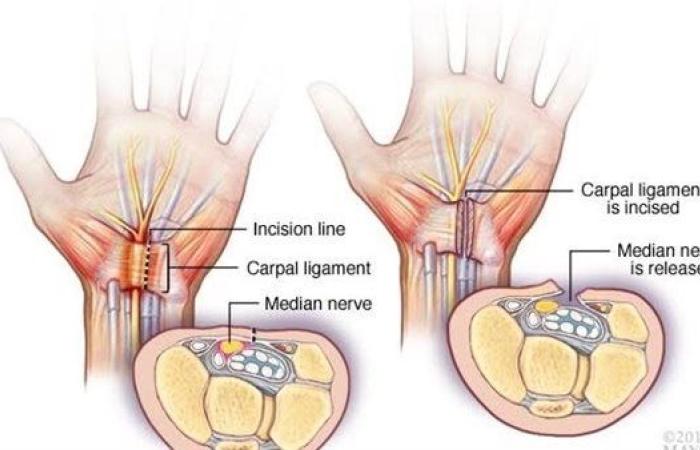 ما هي متلازمة النفق الرسغي وتأثيرها على الجسم؟