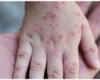 India Reports Its First Case of Virulent Mpox Virus Strain